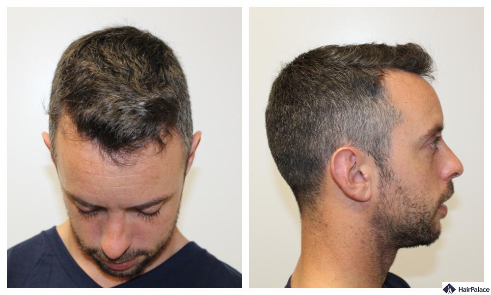 hair loss norwood scale 2